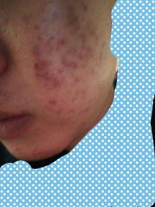 痤疮吃甲氢米瓜